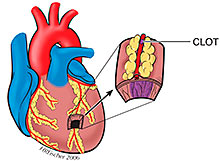Medical illustration heart clot