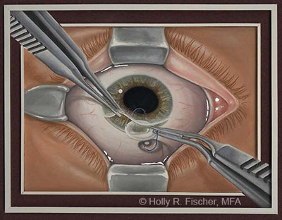 eyesurgery